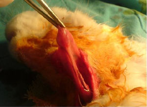 Submandibular gland excision.