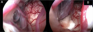 Endoscopic view of the neurovascular conflict before the decompression (A) and after Teflon® sponge interposition between the posterior–inferior cerebellar artery (PICA) and the facial nerve (B).
