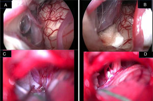 Endoscopic (A, B) and microscopic (C, D) image of a neurovascular conflict before the decompression (A, C) and after Teflon® sheet interposition between the vascular loop and the facial nerve (B, D). It is important to notice the difference in details resolution and anatomical structures definition between endoscopic full-HD technology and microscopic vision. VII, facial nerve; VIII, Statoacoustic nerve; XII, hypoglossal nerve; T, Teflon® sponge; v, vein.
