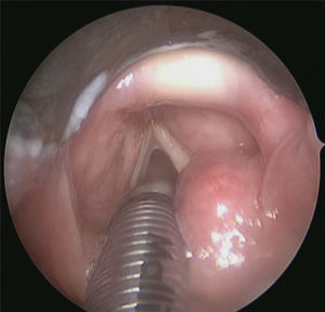 Panendoscopy view of a smooth lesion arising from the right arytenoid region.