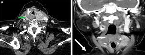 CT scan, with contrast, of the neck. (A) Axial view at C5/6 showing the enhancing right thyroid lobe (green arrow) and the non-enhancing mass arising from the hypopharynx (white arrow). A plane of separation is clearly visible in between. (B) Coronal view of the hypopharyngeal mass (white arrow).