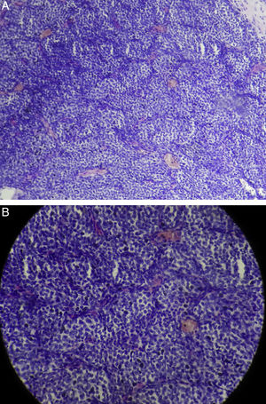 Histopathology pictures showing classical Zellballen pattern pathognomic of paraganglioma. (A) Low magnification; (B) high magnification.