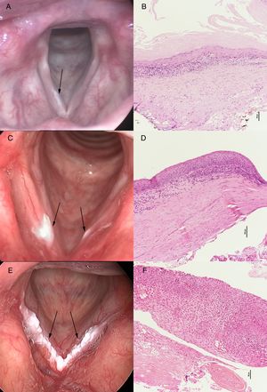 The pathological results of flat and smooth leukoplakia (A), elevated and smooth leukoplakia (C), and rough leukoplakia (E) showed squamous hyperplasia without dysplasia (B), squamous hyperplasia with mild-dysplasia (D), and squamous cell carcinoma (F), respectively.