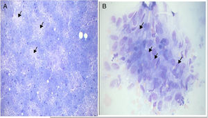 Cytomorphological Type II tuberculosis. A, Caseous necrosis (arrow) and an epithelioid granuloma (MGG ×100).