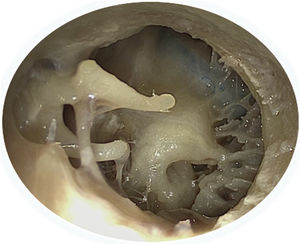 Anatomy of the retro-tympanum (endoscopic view); 1- Ponticulus; Subiculum; 3- Finiculus, 4 - Sinus tympani, 5 - Sinus subtympanicus.
