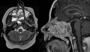 MRI of the head. Axial T1 weighted image (left) and sagittal T1 weighted image (right): an extensive iso- to hypertense lesion of the midface with multilocular conspicuous fluid levels, enhancing septations and solid components. Tumor affected the medial, lateral and ventral wall of the right maxillary sinus. Contralateral it destructed the medial wall of the left maxillary sinus. Erosions of the right bony palate and of major parts of the dorsal septum and the inferior concha nasalis on both sides were observed. The dorsal expansion leads to the clivius, which was partly destructed, and to destruction of the pterygoideus process on the right. Radiologic investigations furthermore revealed partly destruction of the medial wall of the internal carotic artery and partly destruction of the orbital floor and lamina papyracea right.