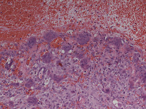 Histopathologic examination: aneurysmatic bone cyst. Microscopy showed multiple cystic spaces filled with blood separated by septae. Fibroblasts, chronic inflammatory cells, giant cells and osteoid without cell atypies were observed. In synopsis with radiologic results and blood tests giant cell tumors, giant cell granuloma and a giant cell tumor in association with hyperparathyroidism were be excluded.