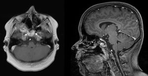 MRI of the head 18 months after primary surgery. Axial T1 weighted image (left) and sagittal T1 weighted image (right): tumor mass was significantly reduced after the first intervention. A minimal residual tumor affecting the clivus and the ethmoid bone can be observed but lesions do not cause any clinical symptoms.