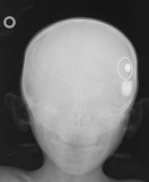 Preoperative radiography of the patient.