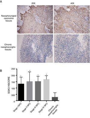 Representative immunohistochemical staining of SGK3 in NPC tissues. (A) Immunohistochemical results showed that SGK3 protein expression was mainly located in the cytoplasm, with strongly positive SGK3 expression in NPC cancer nests and no expression or weak expression in chronic nasopharyngitis tissues. (B) SGK3 expression rate in different stages of NPC and chronic nasopharyngitis tissues according to the HSCORE. The SGK3 expression in stage I, II, III and IV NPC tissues was significantly higher than that in chronic nasopharyngitis tissues (p<0.01). However, no significant difference was observed among the different NPC stages (p>0.05).