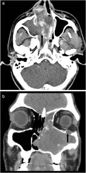 (a) Contrast-enhanced CT scan of the paranasal sinuses axial view showing heterogeneous, soft tissue opacification (black arrow) filling the right maxillary sinus and right nasal cavity pushing the septum to the left. (b) CT scan of the paranasal sinuses coronal view showing expansion of the left maxillary sinus cavity, bone remodelling, widening of the infundibulum and erosion of the orbital floor (black arrow).