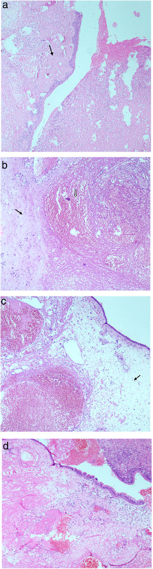 (a) Squamous metaplasia and ulceration replaced by acute inflammatory exudate, arrow pointing towards subepithelial fibrinous exudate (H&E stain at 40×). (b) An ectatic blood vessel with organising thrombus (arrow head) and arrow pointing towards adjacent area of stromal fibrosis (H&E stain at 40×). (c) Respiratory mucosa with marked subepithelial oedema (arrow) and ectatic blood vessels with thrombosis (H&E stain at 40×). (d) Polypoidal respiratory mucosa with subepithelial oedema, marked fibrin exudation and areas of recent haemorrhage (H&E stain at 40×).
