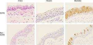 Immunohistochemical staining of pendrin and MUC5AC in the nasal mucosa in the ECRS (B and C) and non-ECRS groups (E and F; original magnification, ×400). An abundant eosinophilic infiltration was shown in the ECRS group (A, arrow). Pendrin staining was intense in the ECRS (B) but absent in the non-ECRS (E) groups. MUC5AC expression was widely observed in the ECRS (C) compared to the non-ECRS (F) groups.