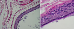 (A) Microscopic view of the epidermoid cyst. Cyst wall lined by keratinizing stratified squamous epithelium and contains keratin flakes (Hematoxylin and Eosin stain, magnification 100×); (B) microscopic view of the epidermoid cyst. Cyst wall lined by keratinizing stratified squamous epithelium (Hematoxylin and Eosin stain, magnification 400×).