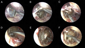 Right ear. (A) Elevation of the tympanomeatal flap from external auditory canal. (B) Visualization of the middle ear cavity via transcanal endoscopic approach. (C) Disconnection of the incudostapedial joint by 90° curved pick. (D) Removing of the stapedial tendon by curved micro-scissors. (E) Separation of the stapes from the oval window as in one piece with footplate. (F) Evaluation of the facial nerve canal dehiscence by micro elevator.