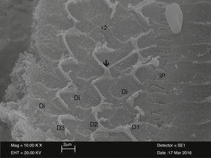SEM view of outer hair cell structures (D1-D2-D3) surrounded by Deiter cells (Di) in the NAC group. The view of the areas of adhesions in apical section of stereocilia (↓) and the areas of loss in outer hair cell (⇒) İP, İnner Pillar cell (10,000×).