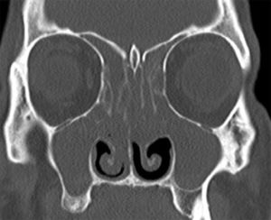 Preoperative paranasal tomography of a patient with exacerbated sinusitis.