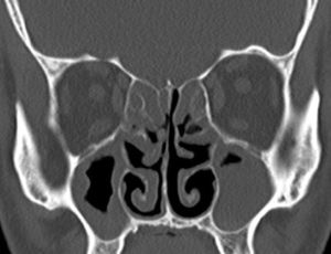 The right half of the case in Fig. 3, one year tomography after performing baloon sinoplasty to the right sinuses and classic FESS operation to the left sinuses.