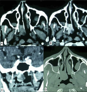(A) Non contrast computerized tomography. (B) Contrast enhanced computerized tomography-axial. (C) Contrast enhanced computerized tomography – coronal view. (D) Computerized tomography – bone window showing no bone involvement.