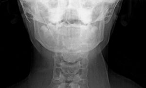 Anteroposterior cervical X-ray.