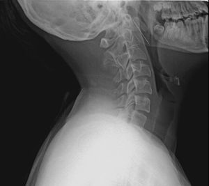 Lateral cervical X-ray.