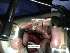 Intraoperative view: insulin syringe needles used as landmarks in intraoperative X-ray imaging and tissue dissection.