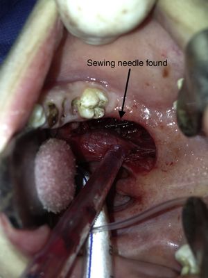 Intraoperative view: sewing needle found in the parapharyngeal space.