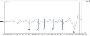 Example of the representation of valleys corresponding to the sustained portion (frequency-following response [FFR]) of the response to BAEP-speech.
