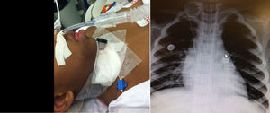 Illustration of patient submitted to hybrid technique with nasotracheal tube in place and capped tracheostomy cannula. On the right, a chest X-ray showing both nasotracheal tube and the 3.5 tube through the tracheostomy in place.