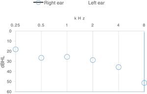 The mean hearing thresholds for the right and left ears.
