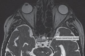 The sinus cavernous lesion (MRI, T2).