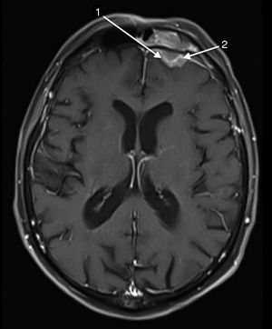 The sinus frontal lesion (MRI, T1). We observed a≥2mm dural thickening (1) and nodular dural enhancement (2) demonstrating the dural invasion.