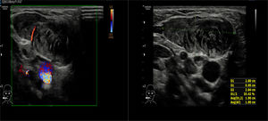 Longitudinal plane of right neck shows heterogenous hypoechoic lesion seen within the right SCM. This lesion measures 2.8cm×0.9cm×2.6cm. No increased in colour Doppler seen within the lesion.