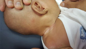 Right neck swelling measuring 2cm×3cm, firm to hard consistency, non-pulsatile with no signs of active inflammation over the level II sternocleidomastoid region.