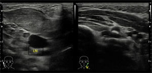 Right Sternocleidomastoid Muscle (SCM) is bulky as compared to the left with loss of normal striations. The lesion is anterior to the right common carotid artery and right internal jugular vein (V, internal jugular vein; LN, lymph node).