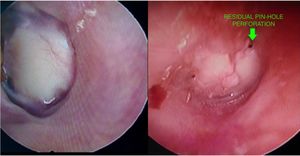A successful full thickness tragal graft take-up and pin-hole residual perforations at the edge of a partial thickness tragal graft.