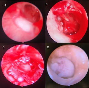 (A) Pre-operative endoscopic view of the tympanic membrane, (B) the surgical field after elevation of the tympanomeatal flap, (C) endoscopic view of the tympanic membrane after grafting, (D) a post-operative endoscopic view of the graft at three months.