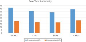 Results of pure tone audiometry.