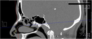 Sagittal reformatted computed tomographic view of nasal cavity. The yellow line indicates the estimated acoustic axis and physiologic nasal airflow.