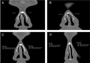 Internal nasal valve angle/area pre and postoperative by reformatted coronal CT-scans. A, angle pre-operative; B; angle post-operative; C, area pre-operative, D, area post-operative.