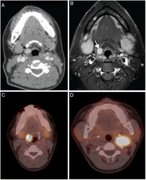 (A–D) 34 year-old woman with laryngeal paraganglioma. Right preepiglottic well defined enhanced mass (arrows) is seen in contrast enhanced CT (A) and contrast enhanced T1 weighted turbo spin echo spectral fat saturation inversion recovery (T1 TSE SPIR); (B) images. Axial 68Gallium-DOTA-peptide PET/CT fusion image (C); shows intense uptake by the right laryngeal paraganglioma similar with syncronous left carotid body paraganglioma (D) (figures of this case were printed in Ref. 5).