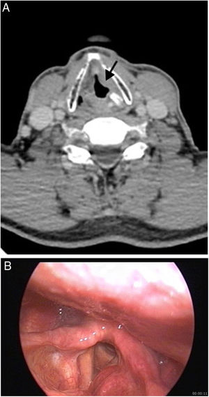 (A and B) 61 year-old man with pulmonary and laryngeal tuberculosis. Contrast enhanced CT image (A) shows a mass on the left band ventricle (arrow) and left arytenoid cartilage sclerosis. Endoscopic image (B) demonstrates a mass on the left band ventricle protruding on the left vocal cord.