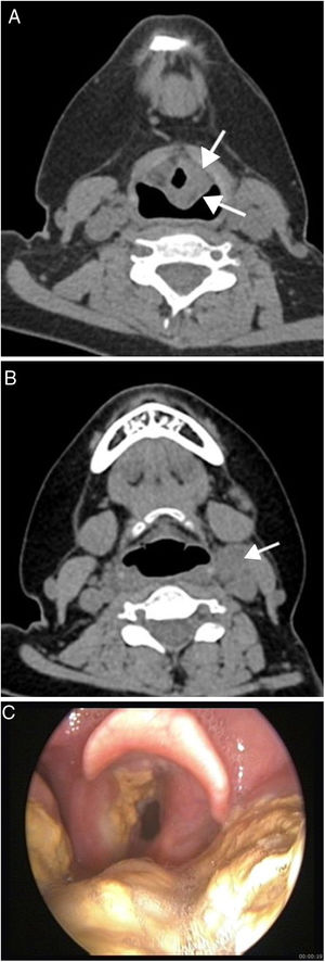 (A–C) 23 year-old woman with posttransplant lymphoproliferative disease, monomorphic, diffuse large B-cell type. Non-enhanced CT shows mass (arrows) (A) on left aryepiglottic fold and left cervical lymphadenopathy (arrow) (B). Endoscopic image (C) reveals irregular yellowish mass involving the left band ventricle, aryepiglottic fold and tongue base.