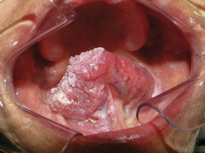 Lesion involvement on the ventral surface of the tongue and part of the buccal floor.