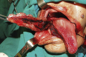 Partial glossectomy.