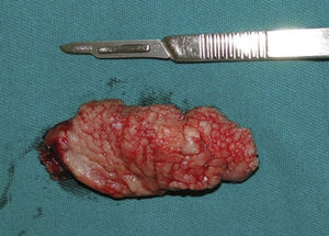 Surgical piece.