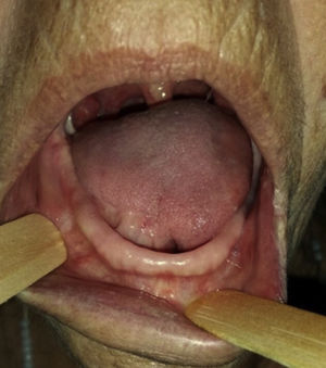 Post-operative period of 20 months.
