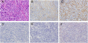 Immunohistochemical examination of LMP1 expression. (A) H&E staining of NPC tissue. (B) LMP1 expression in NPC tissue (+). (C) LMP1 expression in NPC tissue (+++). (D) Negative control of LMP1 staining in NPC tissue. (E) Negative control of LMP1 staining in nasopharyngitis tissue. (F) Weak LMP1 expression in nasopharyngitis tissue. Magnification ×400.
