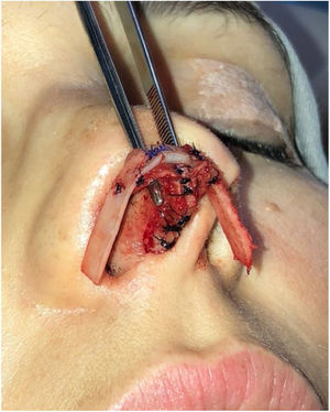 Intraoperative period. Articulated alar rim graft was used in primary closed rhinoseptoplasty, with graft fixation on the lateral crus near the domus.