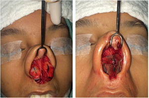 Intraoperative period. Turn in flap maneuver. Initially marked 8mm on the lateral crus from the caudal border and then the cephalic portion is folded under the caudal remnant.